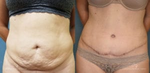 Abdominoplasty Before and After Photos Patient 12C