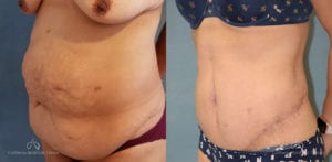 Abdominoplasty Before and After Photos Patient 13A