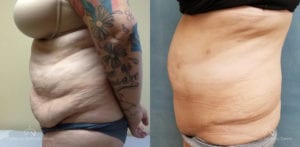 Abdominoplasty Before and After Photos Patient 14A