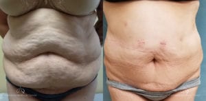 Abdominoplasty Before and After Photos Patient 14c