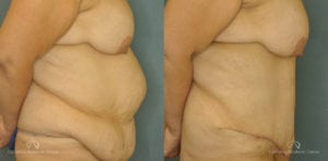 Abdominoplasty Before and After Patient 1A