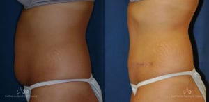 Abdominoplasty Before and After Photos Patient 10A