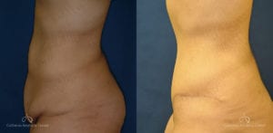 Abdominoplasty Before and After Photos Patient 4A