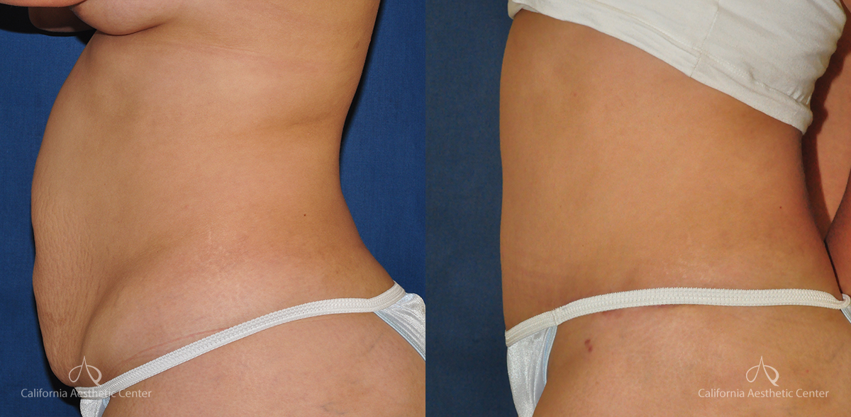 Tummy Tuck Before & After Photos of Patient at The Center for