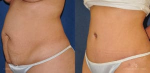 Abdominoplasty Before and After Photos Patient 8B