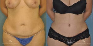 Patient 15 Abdominoplasty Before and After Front View