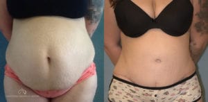 Patient 17 Abdominoplasty Before and After Front View
