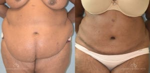 Patient 18 Abdominoplasty Before and After Front View