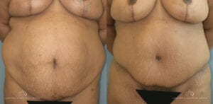 Patient 20 Abdominoplasty Before and After Oblique Left