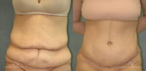 Patient 22 Abdominoplasty Before and After Front