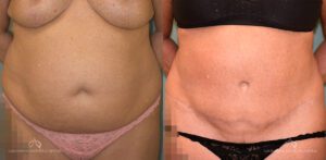 Patient 26 - Abdominoplasty Front Before and After
