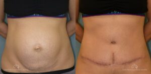 Patient 27 - Abdominoplasty Front Before and After