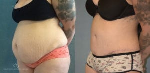 Patient 17 Abdominoplasty Before and After Left Oblique View