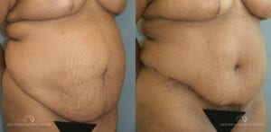 Patient 20 Abdominoplasty Before and After Oblique Left