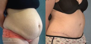 Patient 17 Abdominoplasty Before and After Right Oblique View