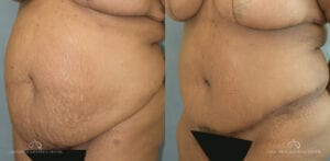 Patient 20 Abdominoplasty Before and After Oblique Right