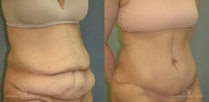 Patient 22 Abdominoplasty Before and After Oblique Right