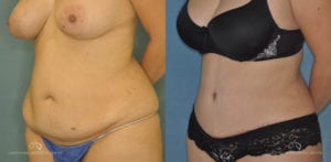 Patient 15 Abdominoplasty Before and After Left Oblique View