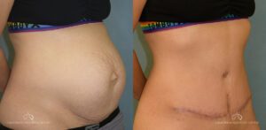 Patient 27 - Abdominoplasty Oblique Before and After