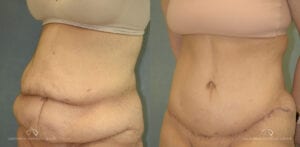 Patient 22 Abdominoplasty Before and After Oblique Left