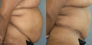 Patient 20 Abdominoplasty Before and After Side Left