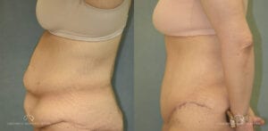 Patient 22 Abdominoplasty Before and After Side Left