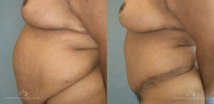 Patient 20 Breast Reduction Before and After Side Right