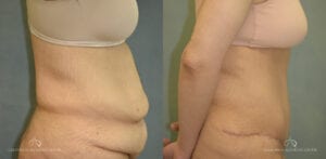Patient 22 Abdominoplasty Before and After Side Right
