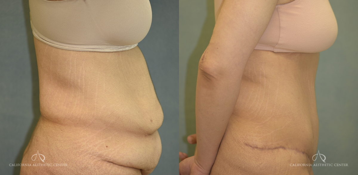Is a Mini Tummy Tuck Right for You?