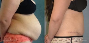 Patient 17 Abdominoplasty Before and After Right Side View
