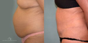 Patient 26 - Abdominoplasty Side Before and After