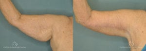 Brachioplasty Before and After Patient 1A