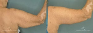 Brachioplasty Before and After Patient 1B