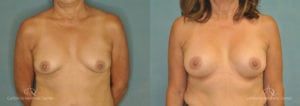 Breast Augmentation Before and After Patient 1E