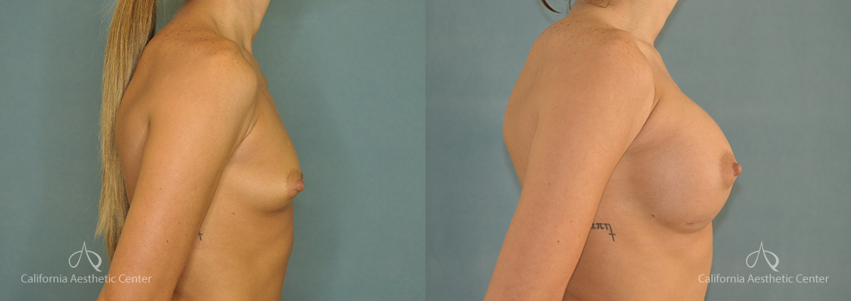 Breast Augmentation Before and After Patient 2A