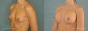 Breast Augmentation Before and After Patient 2D