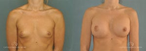 Breast Augmentation Before and After Patient 2E