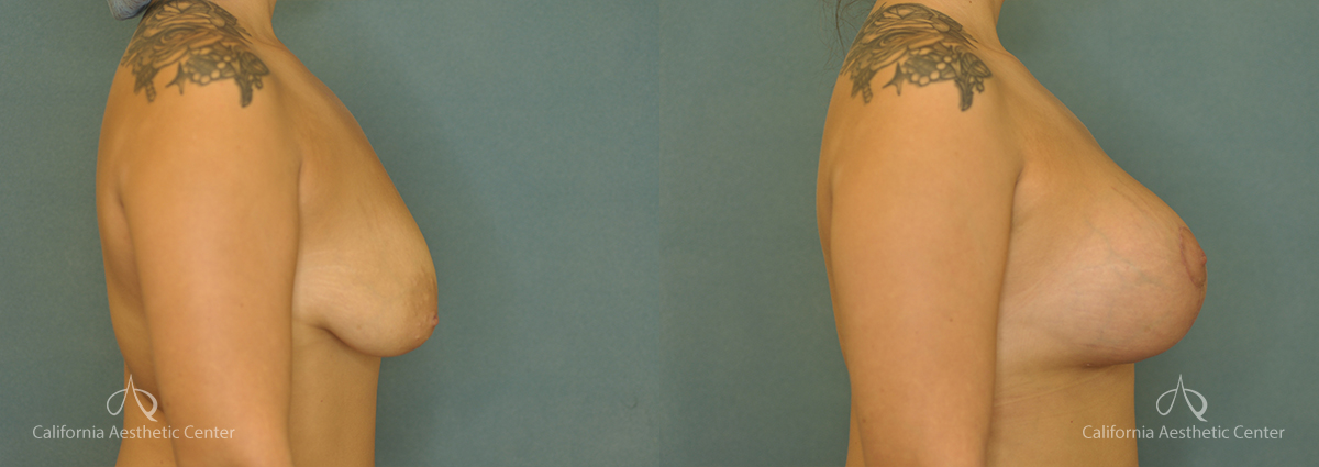 Breast Augmentation Before and After Patient 3A