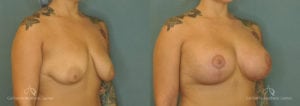 Breast Augmentation Before and After Patient 3B