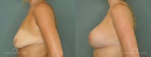 Breast Augmentation Before and After Patient 5C