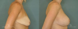 Breast Lift Before and After Photos Patient 1A
