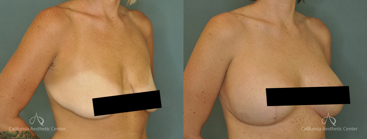 Breast Lift with Augmentation Huntington Beach Dr. Vu