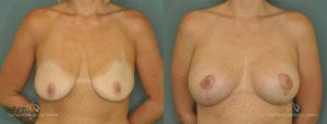 Breast Lift Before and After Photos Patient 1C