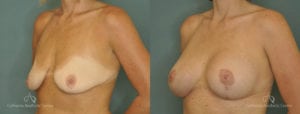 Breast Lift Before and After Photos Patient 1D