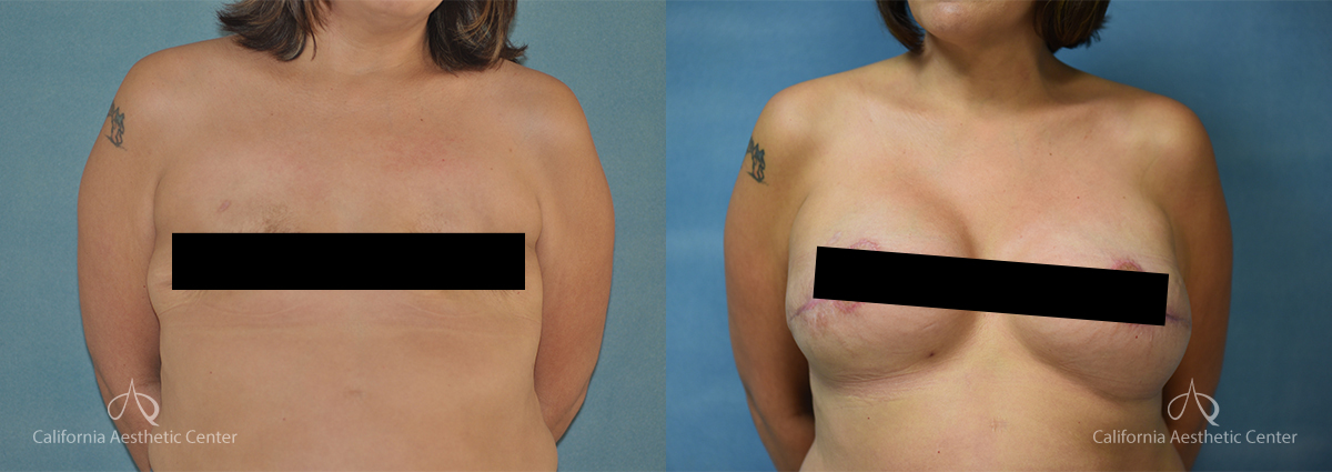 What Does Drop and Fluff Mean After Breast Augmentation? - The Vu Center