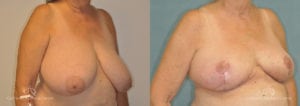 Breast Reduction Before and After Photos Patient 1A