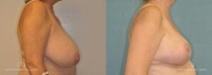 Breast Reduction Before and After Photos Patient 1B