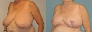 Breast Reduction Before and After Photos Patient 1D