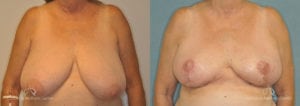 Breast Reduction Before and After Photos Patient 1E