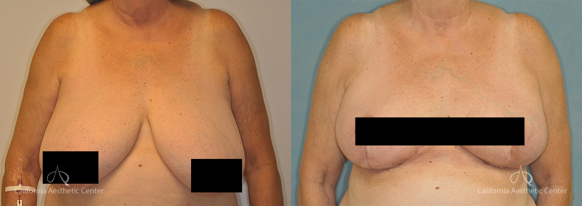 Breast Reduction Huntington Beach, Orange County